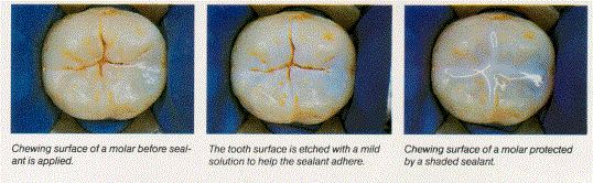 Dental Care Kids Pediatric & Orthodontic dentistry - before and after sealant